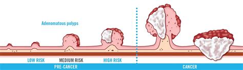 Colorectal cancer risk factors - If you have a colon, you're at risk.