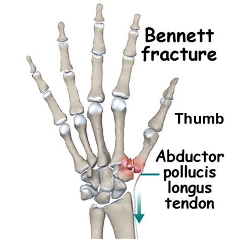 Bennett fracture causes, symptoms, diagnosis, treatment & prognosis