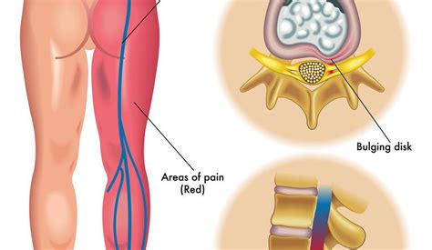 sciatic nerve pain in buttocks Archives - SAMARPAN PHYSIOTHERAPY CLINIC ...