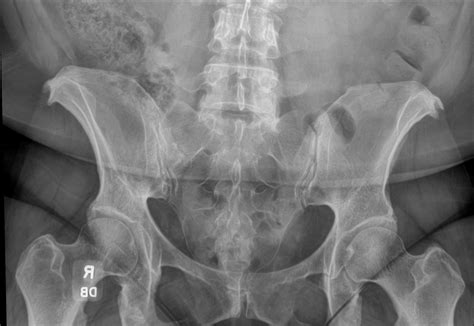 OrthoDx: Sacral Fracture - Clinical Advisor