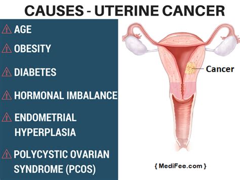 Endometrial Cancer - Types, Symptoms, Diagnosis & Prevention