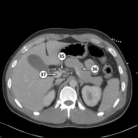 Why Ct Scan Abdomen Pelvis