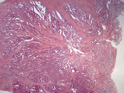 Neoplastic polypoid lesion of the cecum. Histology revealed a ...