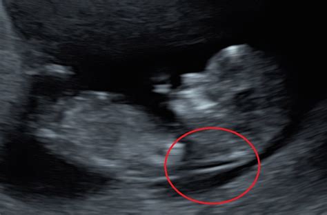 What is a Nuchal Translucency Scan? - The Ultrasound SuiteThe ...