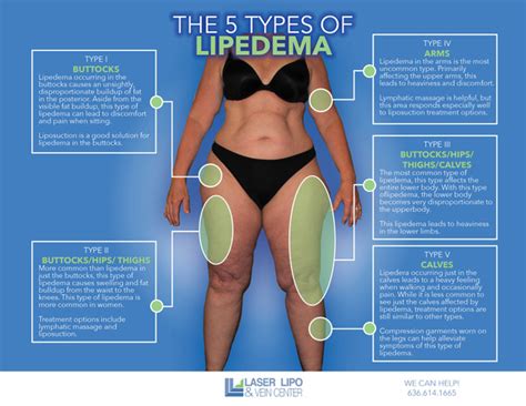 Lipedema Awareness Month and Tips for Managing Symptoms | LLAV