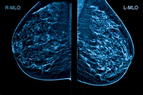 Breast Density Information to Become a Regular Part of Mammogram ...