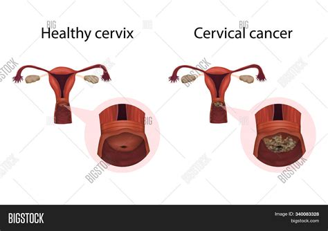 Cervix Cancer Healthy Image & Photo (Free Trial) | Bigstock