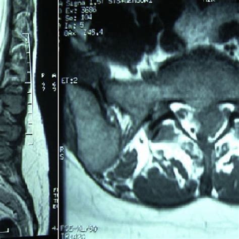 Case 2 MRI was performed revealing L5-S1 disc protrusion. | Download ...