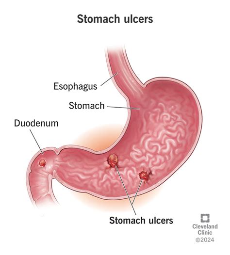 Stomach (Peptic) Ulcer: Signs, Symptoms, Causes & Treatment