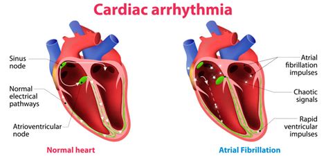 How to Manage Heart Arrhythmia? - Heart Disease