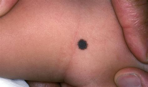 Common Birthmarks