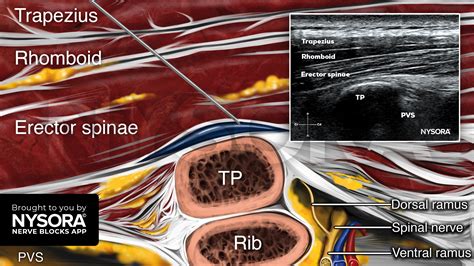 Tips for an Erector Spinae Plane Block - NYSORA