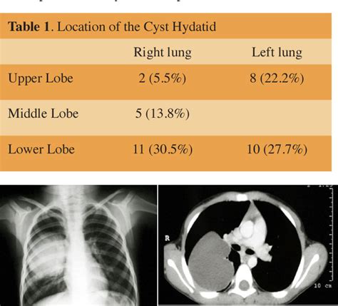 Table 1 from Diagnosis and treatment approaches of the lung hydatid ...