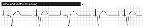 Interpretation of Pacemaker ECG – Cardiovascular Education