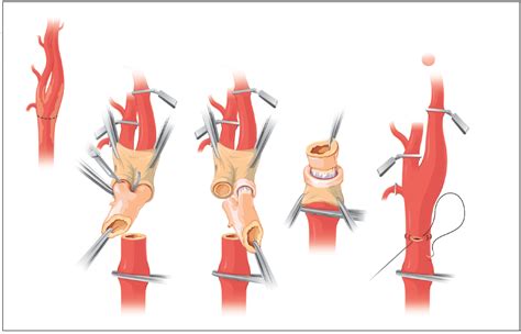 Carotid Endarterectomy: The Eversion Technique - Endovascular Today