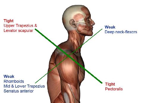 Active Physio Works :: Neck pain? What are these deep neck flexors ...