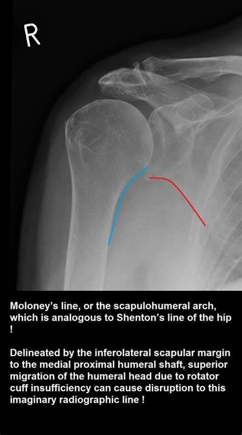 Rotator Cuff Insufficiency - decreased acromiohumeral interval with ...