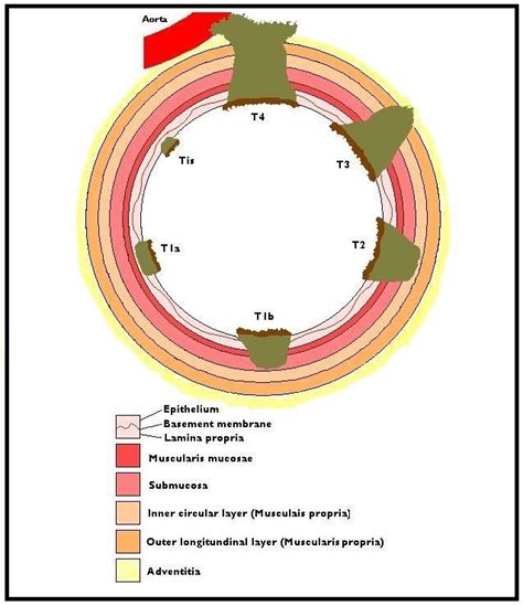 Cross section of esophageal wall depicting T stage according to depth ...