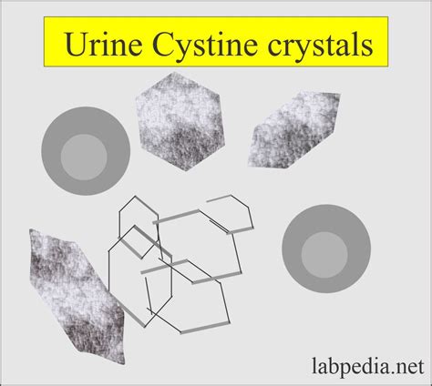 Urine Crystals (Crystalluria) - Labpedia.net