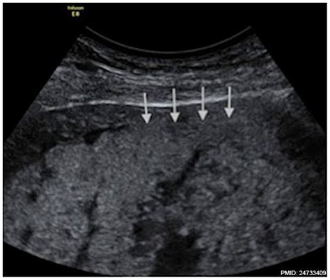 File:Placenta accreta ultrasound retroplacental clear space loss.jpg ...