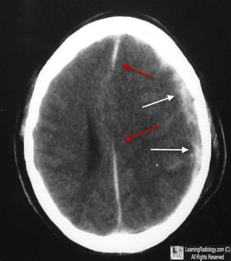 Learning Radiology - subdural, hematoma