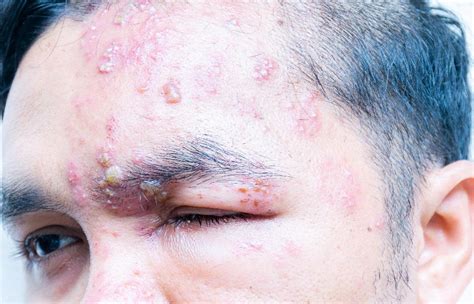 Shingles Symptoms