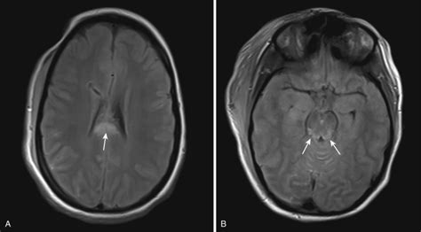 Traumatic Brain Injury | Radiology Key