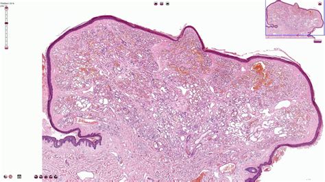 Capillary Hemangioma - Skin, Histopathology - YouTube