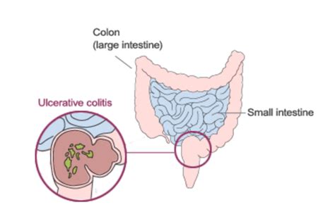 Ulcerative Colitis and Proctitis - Gastroenterologist