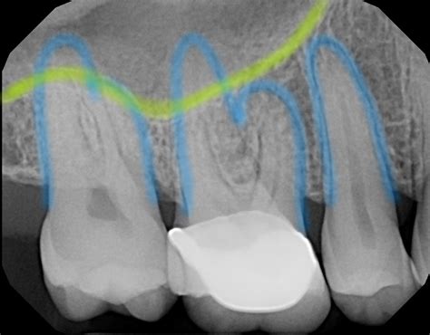 Dental Questions: Are sinus infections and pain on upper teeth related ...