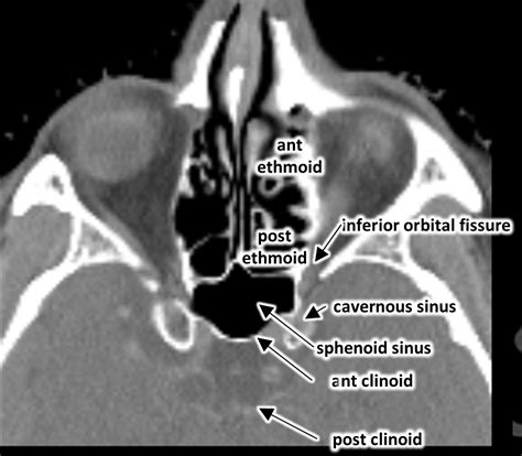 Superior Orbital Fissure Radiology