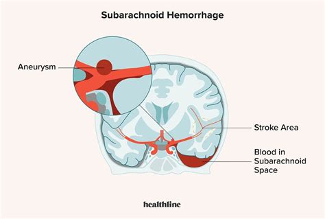 Intraparenchymal Hemorrhage Vs Subarachnoid Hemorrhage