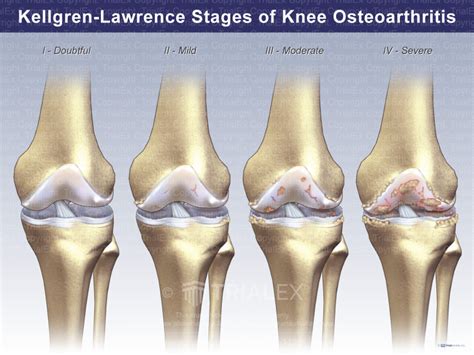 Kellgren-Lawrence Stages of Knee Osteoarthritis - TrialQuest Inc.