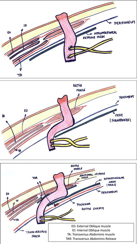 tödlich Wohnzimmer Verfügbar parastomalhernia mesh complications Mini ...