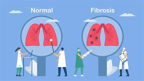 15+ Pulmonary Fibrosis Stage 4 Symptoms (and Treatment)