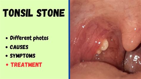 Tonsil stone | Cause, symptoms, treatment & photos - YouTube