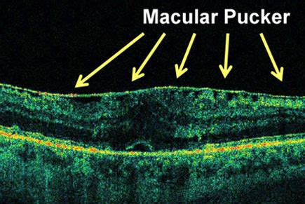 Macular Pucker in Los Angeles, CA | The Retina Partners