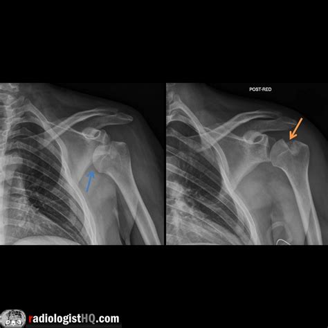 Anterior shoulder dislocation with Hill-Sachs lesion on x-ray : r/Radiology