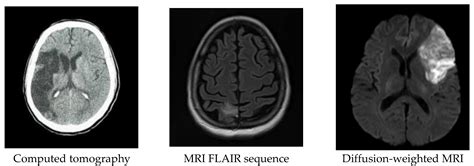 Stroke Brain Mri