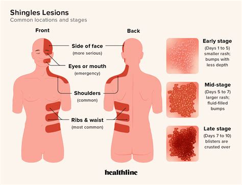 Shingles Symptoms