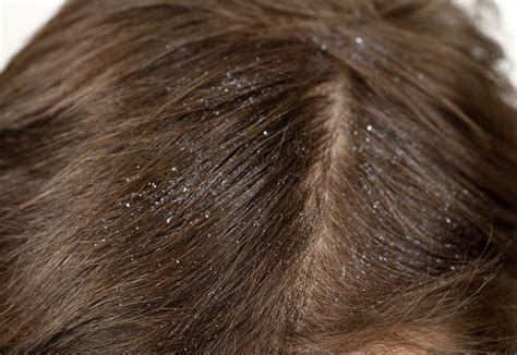 Dandruff Causes & Treatment - Weldricks Pharmacy