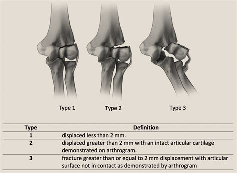 Pdf Acute Lateral Condyle Fractures Of The Humerus | The Best Porn Website