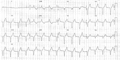 Accelerated Idioventricular Rhythm (AIVR) • LITFL • ECG Library