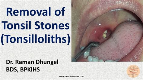 Tonsil Stone Removal - Tonsillolith removal by Dr. Raman Dhungel - YouTube