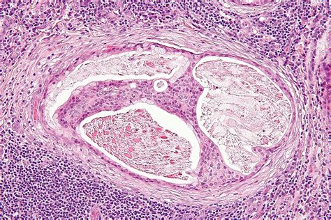 File:Mucoepidermoid carcinoma - 2 - high mag.jpg - Libre Pathology