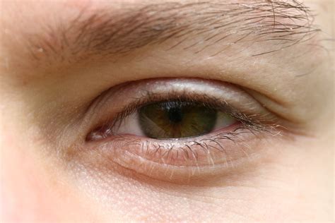 Scratched eye symptoms | eHow UK