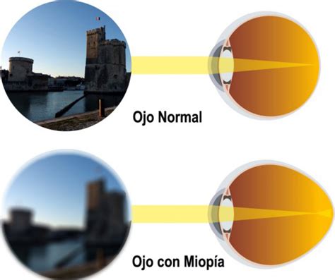 Retina Vitreo > Miopía. - IOBA | Instituto Universitario de ...