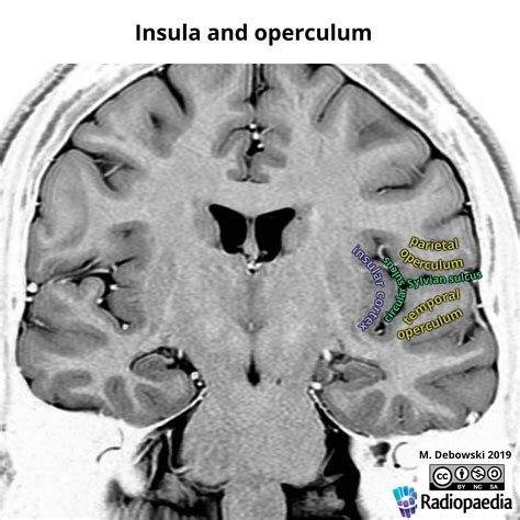 Insular Cortex Mri