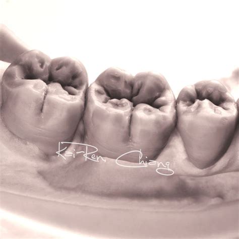 Diagnostic wax-up #posteriorteeth #dentalwax #dentaltech #dentalwork # ...