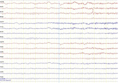 Standard EEG - Entabeni Epilepsy Laboratory